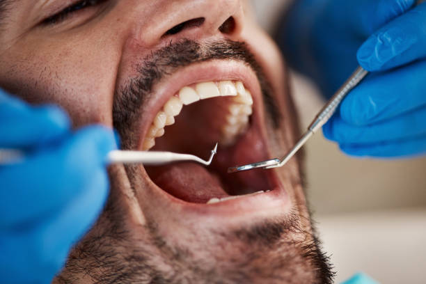 Best Emergency Tooth Extraction in Richmond, IN